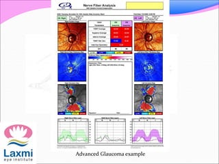 Advanced Glaucoma example
 