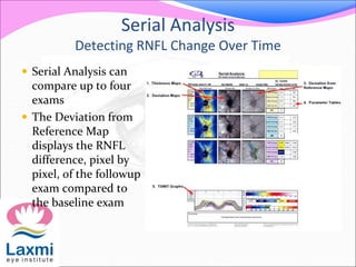 Serial Analysis
Detecting RNFL Change Over Time
 Serial Analysis can
compare up to four
exams
 The Deviation from
Reference Map
displays the RNFL
difference, pixel by
pixel, of the followup
exam compared to
the baseline exam
 