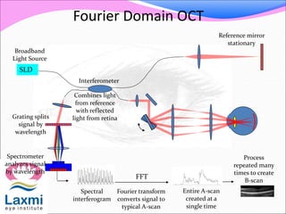 Fourier Domain OCT
SLD
Spectrometer
analyzes signal
by wavelength
FFT
Grating splits
signal by
wavelength
Broadband
Light Source
Reference mirror
stationary
Combines light
from reference
with reflected
light from retina
Interferometer
Spectral
interferogram
Fourier transform
converts signal to
typical A-scan
Entire A-scan
created at a
single time
Process
repeated many
times to create
B-scan
 