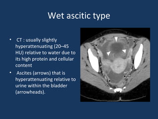 Wet ascitic type
• CT : usually slightly
hyperattenuating (20–45
HU) relative to water due to
its high protein and cellular
content
• Ascites (arrows) that is
hyperattenuating relative to
urine within the bladder
(arrowheads).
 