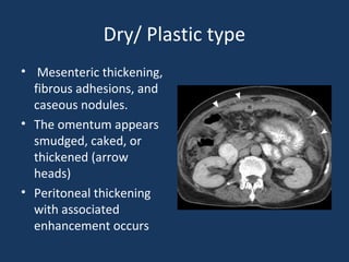 Dry/ Plastic type
• Mesenteric thickening,
fibrous adhesions, and
caseous nodules.
• The omentum appears
smudged, caked, or
thickened (arrow
heads)
• Peritoneal thickening
with associated
enhancement occurs
 
