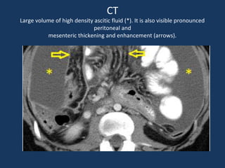 CT
Large volume of high density ascitic fluid (*). It is also visible pronounced
peritoneal and
mesenteric thickening and enhancement (arrows).
 