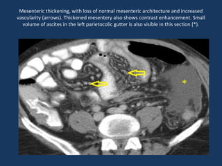 Mesenteric thickening, with loss of normal mesenteric architecture and increased
vascularity (arrows). Thickened mesentery also shows contrast enhancement. Small
volume of ascites in the left parietocolic gutter is also visible in this section (*).
 
