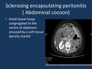 Sclerosing encapsulating peritonitis
( Abdominal cocoon)
• Small bowel loops
congregated to the
centre of abdomen
encased by a soft tissue
density mantle
 