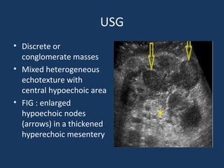 USG
• Discrete or
conglomerate masses
• Mixed heterogeneous
echotexture with
central hypoechoic area
• FIG : enlarged
hypoechoic nodes
(arrows) in a thickened
hyperechoic mesentery
 