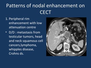 Patterns of nodal enhancement on
CECT
1. Peripheral rim
enhancement with low
attenuation centre
• D/D : metastasis from
testicular tumors, head
and neck squamous cell
cancers,lymphoma,
whipples disease,
Crohns ds.
 
