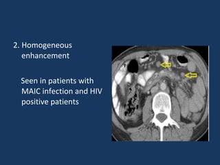 2. Homogeneous
enhancement
Seen in patients with
MAIC infection and HIV
positive patients
 