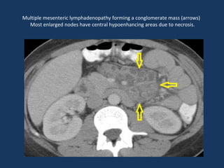 Multiple mesenteric lymphadenopathy forming a conglomerate mass (arrows)
Most enlarged nodes have central hypoenhancing areas due to necrosis.
 