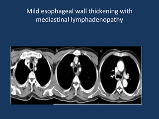 Mild esophageal wall thickening with
mediastinal lymphadenopathy
 