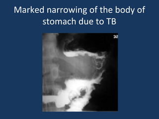Marked narrowing of the body of
stomach due to TB
 