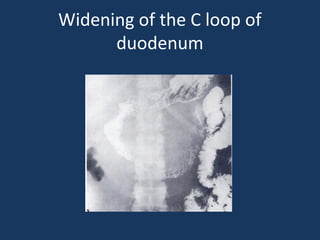 Widening of the C loop of
duodenum
 