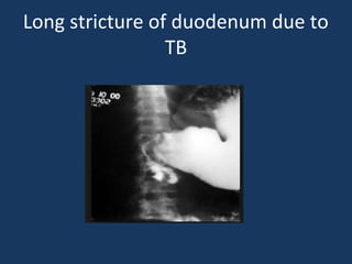 Long stricture of duodenum due to
TB
 
