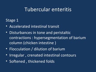 Tubercular enteritis
Stage 1
• Accelerated intestinal transit
• Disturbances in tone and peristaltic
contractions : hypersegmentation of barium
column (chicken intestine )
• Flocculation / dilution of barium
• Irregular , crenated intestinal contours
• Softened , thickened folds
 