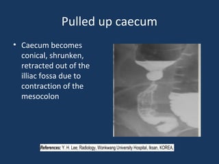 Pulled up caecum
• Caecum becomes
conical, shrunken,
retracted out of the
illiac fossa due to
contraction of the
mesocolon
 