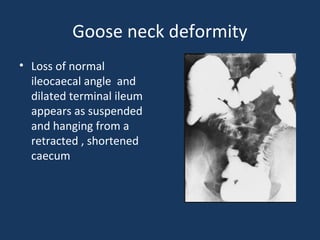 Goose neck deformity
• Loss of normal
ileocaecal angle and
dilated terminal ileum
appears as suspended
and hanging from a
retracted , shortened
caecum
 