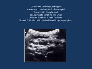 USG shows thlckened, echogenic
mesentery containing multiple enlarged
hypoechoic, discrete, and
conglomerate lymph nodes. Small
amount of ascites is seen (arrows).
Dilated, fluid-filled, thick-walled bowel loops at periphery.
 