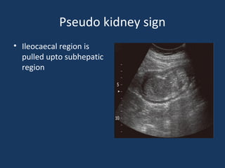 Pseudo kidney sign
• Ileocaecal region is
pulled upto subhepatic
region
 