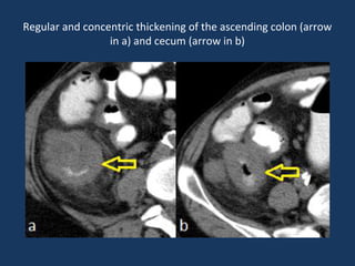 Regular and concentric thickening of the ascending colon (arrow
in a) and cecum (arrow in b)
 