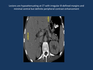 Lesions are hypoattenuating at CT with irregular ill-defined margins and
minimal central but definite peripheral contrast enhancement
 