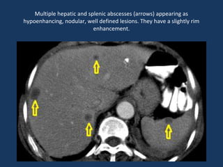 Multiple hepatic and splenic abscesses (arrows) appearing as
hypoenhancing, nodular, well defined lesions. They have a slightly rim
enhancement.
 