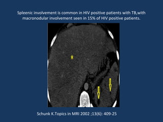 Spleenic involvement is common in HIV positive patients with TB,with
macronodular involvement seen in 15% of HIV positive patients.
Schunk K.Topics in MRI 2002 ;13(6): 409-25
 