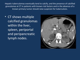 Hepatic tuberculomas eventually tend to calcify, and the presence of calcified
granulomas at CT in patients with known risk factors and in the absence of a
known primary tumor should raise suspicion for tuberculosis.
• CT shows multiple
calcified granulomas
within the liver,
spleen, periportal
and peripancreatic
lymph nodes.
 