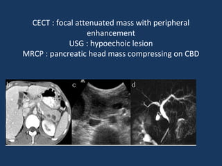 CECT : focal attenuated mass with peripheral
enhancement
USG : hypoechoic lesion
MRCP : pancreatic head mass compressing on CBD
 