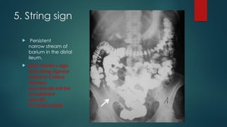 IMAGING IN ABDOMINAL TB - RADIOLOGICAL ASPECT (BY - DR SIDDHARTH PANDEY ...