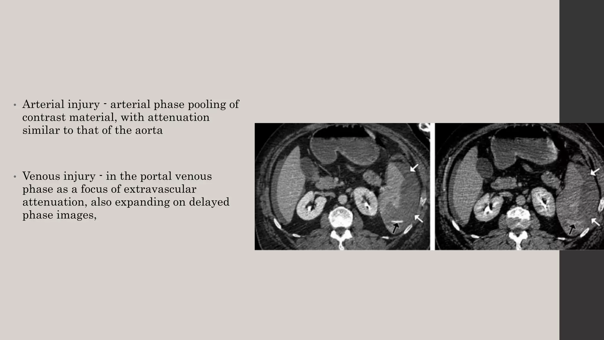 Contrast Pooling Bowel and mesenteric injury | PPTX