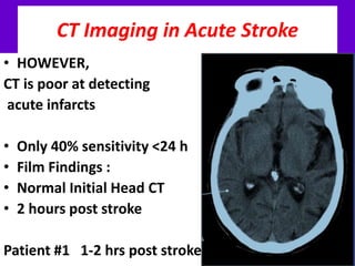 CT Imaging in Acute Stroke
• HOWEVER,
CT is poor at detecting
acute infarcts
• Only 40% sensitivity <24 h
• Film Findings :
• Normal Initial Head CT
• 2 hours post stroke
Patient #1 1-2 hrs post stroke
 
