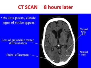 CT SCAN 8 hours later
 
