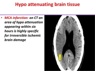 Hypo attenuating brain tissue
• MCA infarction: on CT an
area of hypo attenuation
appearing within six
hours is highly specific
for irreversible ischemic
brain damage
 
