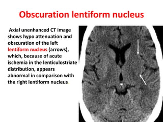 Obscuration lentiform nucleus
Axial unenhanced CT image
shows hypo attenuation and
obscuration of the left
lentiform nucleus (arrows),
which, because of acute
ischemia in the lenticulostriate
distribution, appears
abnormal in comparison with
the right lentiform nucleus.
 