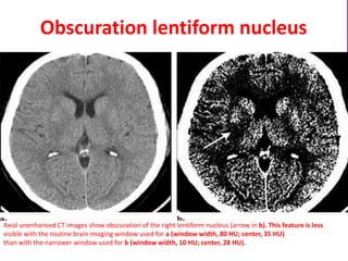Obscuration lentiform nucleus
Axial unenhanced CT images show obscuration of the right lentiform nucleus (arrow in b). This feature is less
visible with the routine brain imaging window used for a (window width, 80 HU; center, 35 HU)
than with the narrower window used for b (window width, 10 HU; center, 28 HU).
 