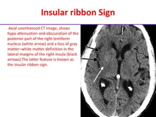 Insular ribbon Sign
Axial unenhanced CT image, shows
hypo attenuation and obscuration of the
posterior part of the right lentiform
nucleus (white arrow) and a loss of gray
matter–white matter definition in the
lateral margins of the right insula (black
arrows).The latter feature is known as
the insular ribbon sign.
 