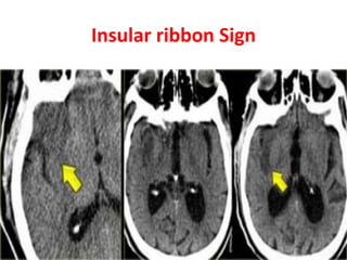 Insular ribbon Sign
 