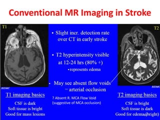 Conventional MR Imaging in Stroke
? Absent R. MCA Flow Void
(suggestive of MCA occlusion)
 