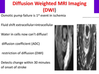 Diffusion Weighted MRI Imaging
(DWI)
Osmotic pump failure is 1st event in ischemia
Fluid shift extracellular>intracellular
Water in cells now can’t diffuse!
diffusion coefficient (ADC)
restriction of diffusion (DWI)
Detects change within 30 minutes
of onset of stroke
 