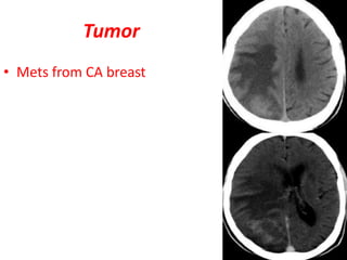 Tumor
• Mets from CA breast
 