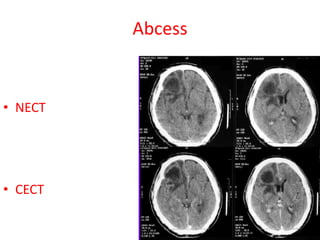 Abcess
• NECT
• CECT
 
