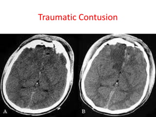 Traumatic Contusion
 