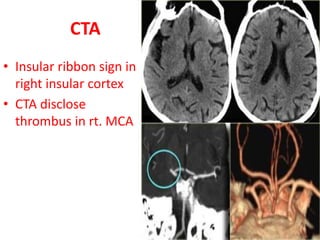 CTA
• Insular ribbon sign in
right insular cortex
• CTA disclose
thrombus in rt. MCA
 