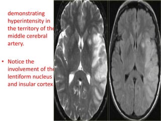 • T2WI and FLAIR
demonstrating
hyperintensity in
the territory of the
middle cerebral
artery.
• Notice the
involvement of the
lentiform nucleus
and insular cortex.
 