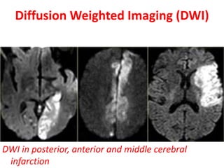 DWI in posterior, anterior and middle cerebral
infarction
Diffusion Weighted Imaging (DWI)
 