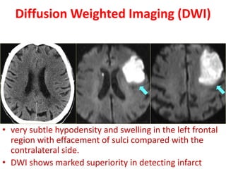 Diffusion Weighted Imaging (DWI)
• very subtle hypodensity and swelling in the left frontal
region with effacement of sulci compared with the
contralateral side.
• DWI shows marked superiority in detecting infarct
 