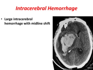 Intracerebral Hemorrhage
• Large intracerebral
hemorrhage with midline shift
 
