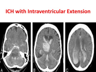 ICH with Intraventricular Extension
 