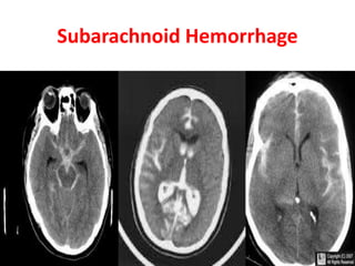 Subarachnoid Hemorrhage
 