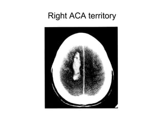Imaging in acute stroke | PPT