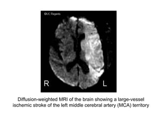 Diffusion-weighted MRI of the brain showing a large-vessel
ischemic stroke of the left middle cerebral artery (MCA) territory
 